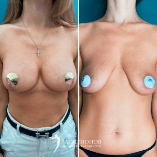 подтяжка груди с имплантатами